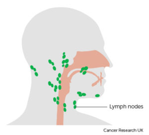 Neck dissection information - Milton Keynes University Hospital