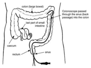 Flexible Sigmoidoscopy - Milton Keynes University Hospital