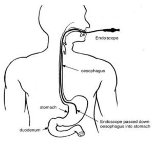 Gastroscopy with Banding of Oesophageal Varices or Injection of ...