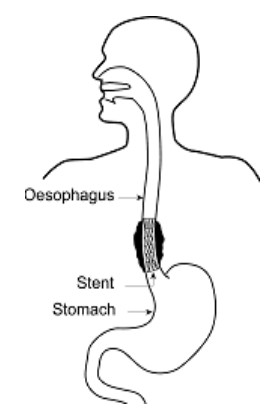 Eating when you have an oesophageal stent - Milton Keynes University ...