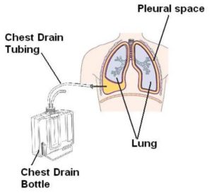 Looking After Your Chest Drain - Milton Keynes University Hospital