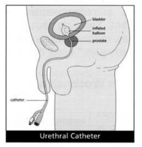 Going Home with a Catheter - Milton Keynes University Hospital