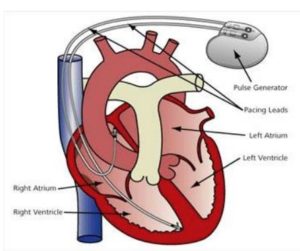 Cardiac Angiography Unit Pacemaker Implant Pre-Procedure leaflet ...