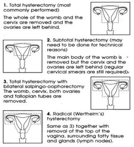 Hysterectomy - Milton Keynes University Hospital