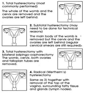 Hysterectomy - Milton Keynes University Hospital