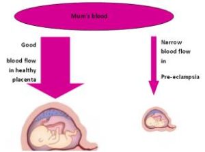 Reducing The Risk Of Pre-eclampsia - Information For Women Taking ...